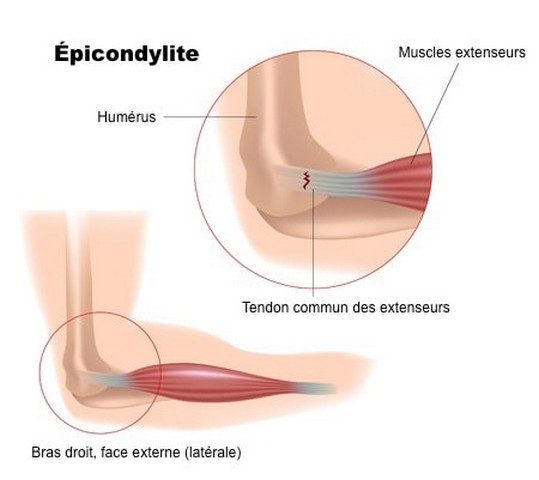 tennis elbow traitement 005